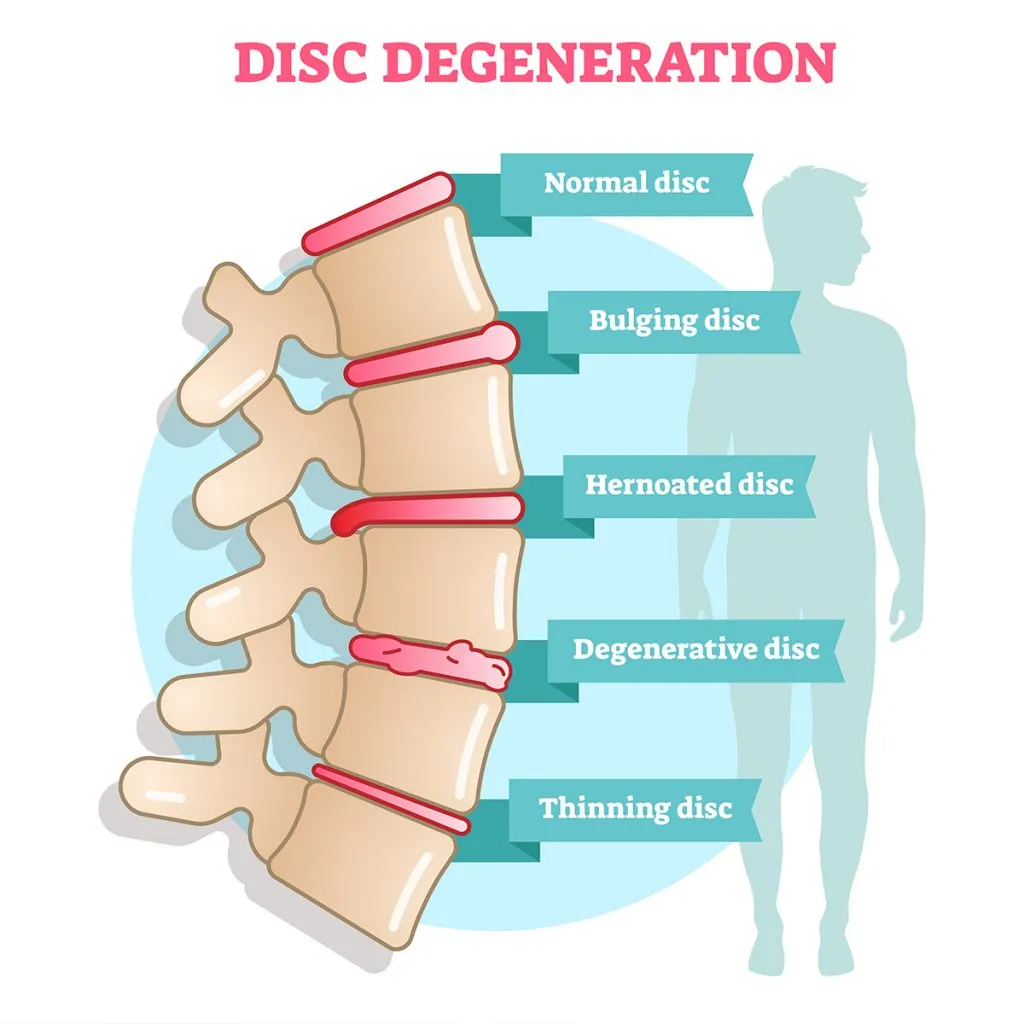Diagram showing degenerative disc disease in the lumbar spine