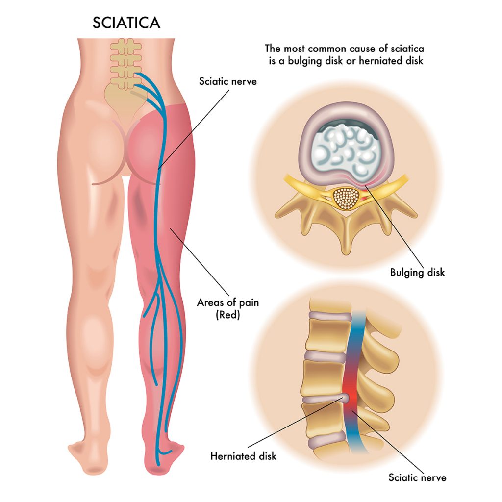 Graphic image presenting sciatica
