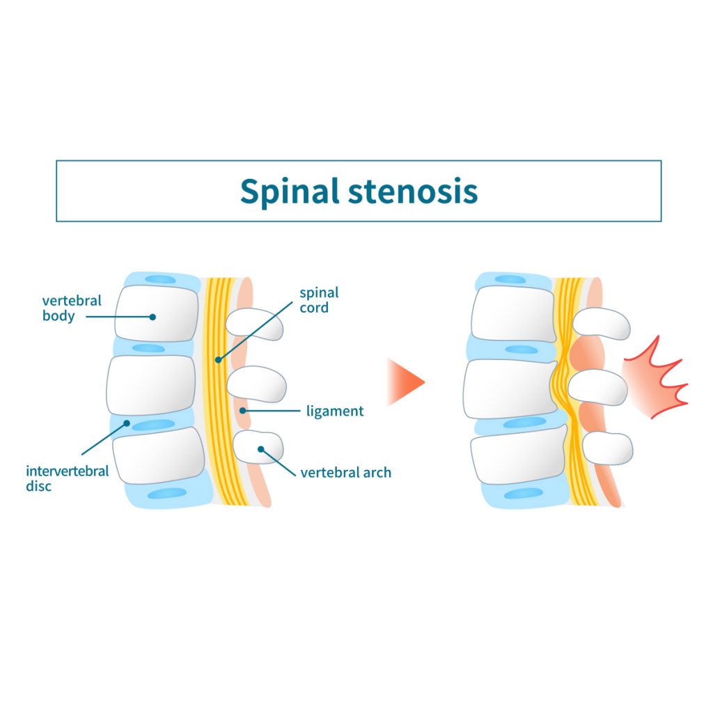 Spinal stenosis graphic