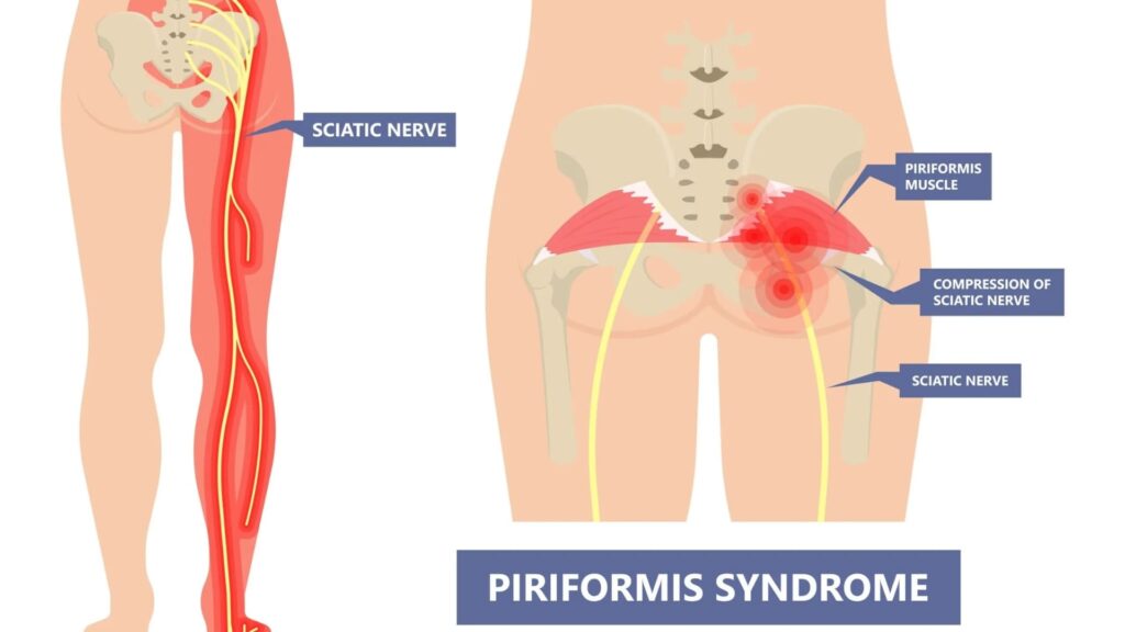Piriformis Syndrome