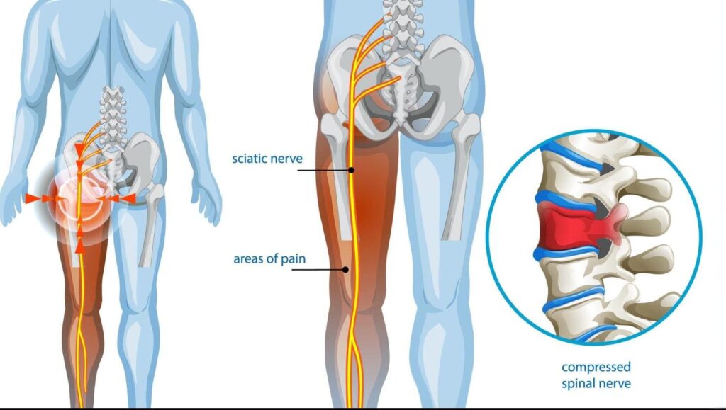 Sciatica
