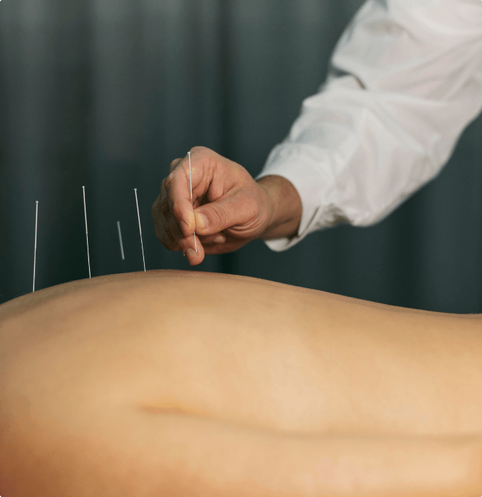 Dry needling treatment for back muscle trigger points in Niles IL