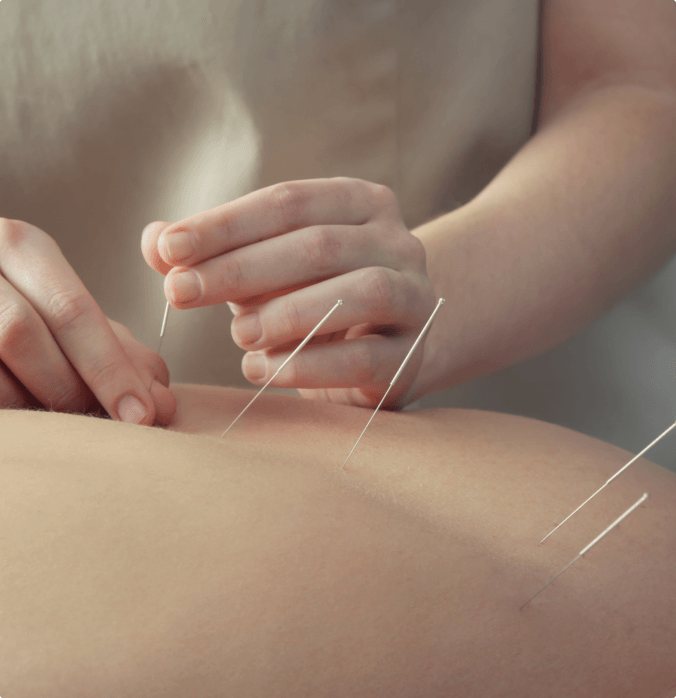 Clinician performing dry needling on shoulder muscle
